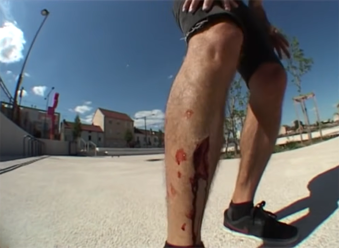 What Are The Most Common Skateboarding Injuries?